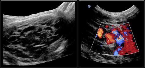 Can Ultrasound Detect Cancer In The Neck Head And Neck Ultrasound