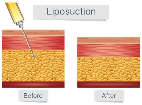 Liposuction Medical Treatment And Comparison 297952 Vector Art At Vecteezy