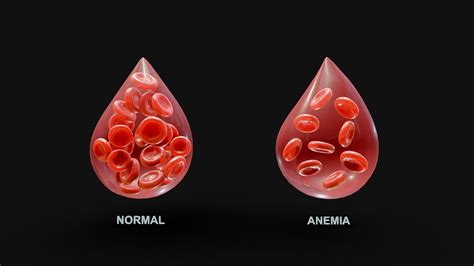 Normal Blood Cells Vs Anemia Buy Royalty Free 3d Model By Nima