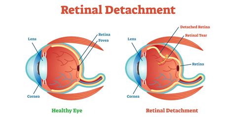 What Is Retinal Detachment Various Types Causes And Treatments