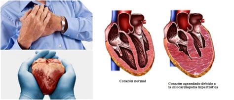 ¿qué Es La Cardiomiopatía O Miocardiopatía Causas Síntomas Factores