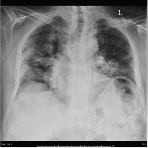 Chest X Rays Of Two Patients A And B A Peripheral Focal Areas Of