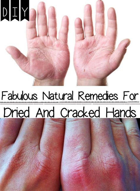 natural remedies for dried and cracked hands dry hands remedy cracked hands dry hands