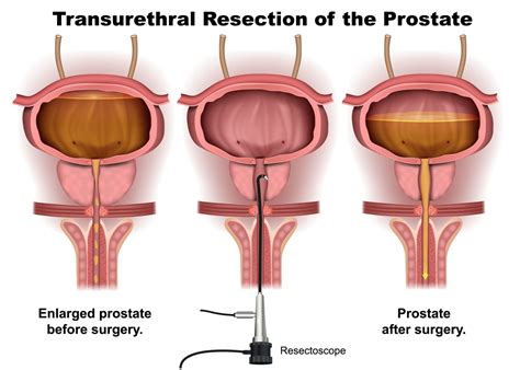 When To Consider Turp For Bph New York City Prostate Center