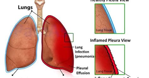 Find out what rhymes with pleurisy. About Health: Pleurisy