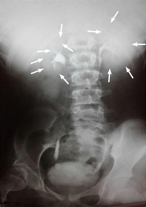Unilateral Hypoplastic Kidney In Adults An Experience Of A Tertiary