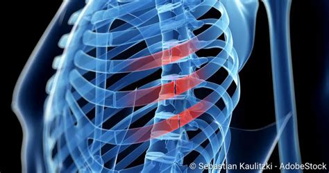 Rib Fracture Broken Ribs Symptoms Treatment Healing Time Medical Society