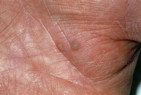 View Of Two Warts On The Palm Of A Hand Stock Image M2900097