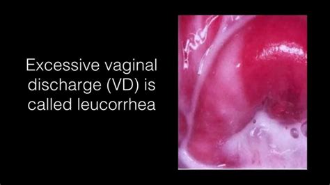 What Does Leukorrhea Look Like Hiccups Pregnancy