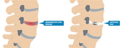 Artificial Disc Replacement Vs Spinal Fusion Altair Health