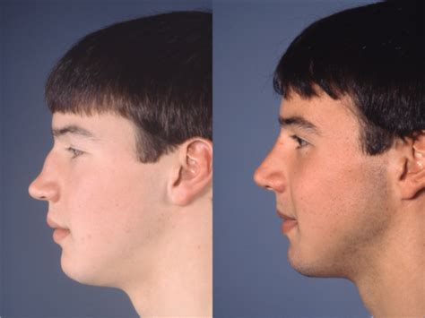 Photos Saddle Nose Deformity Before And After Repair Rhinoplasty In My Xxx Hot Girl