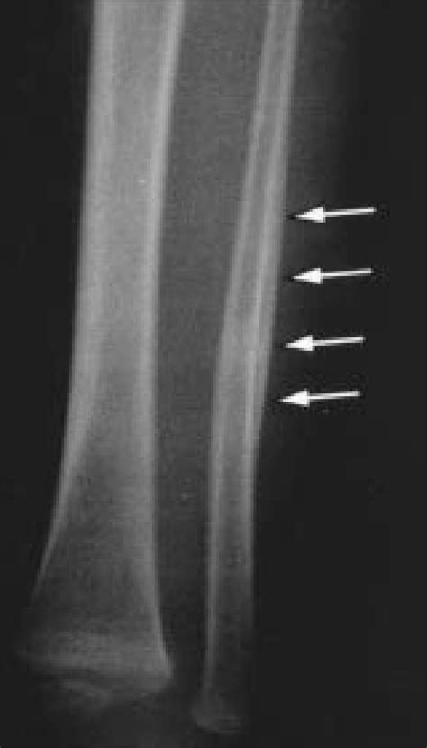 Toddlers Fracture Of Fibula In 15 Month Old Male Infant Radiograph