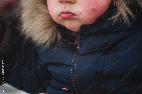 Two Years Old Boy Child With Red Cheeks Enterovirus Infection