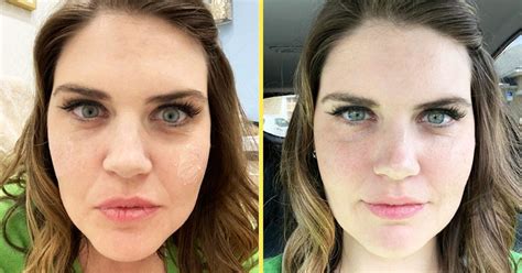 I Got Under Eye Fillers And Here Are 5 Things To Know