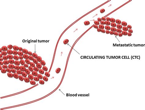 Illustration Of Circulating Tumor Cells Ctc Forming Metastasis Tumor