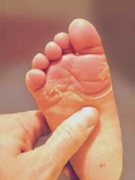 If you overexpose your skin to the sun's rays, you may experience. Acral peeling skin syndrome on the feet. | Download ...
