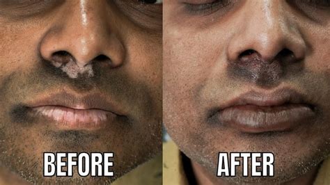 Lip Vitiligo Treatment In India Lip Vitiligo Pigmentoz Treatment Lip