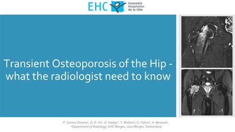 Pdf Transient Osteoporosis Of The Hip What The Radiologist Need To Know