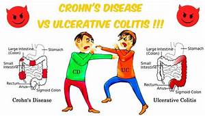 Crohn 39 S Vs Ulcerative Colitis The Battle Of The Bowels Ulcerative