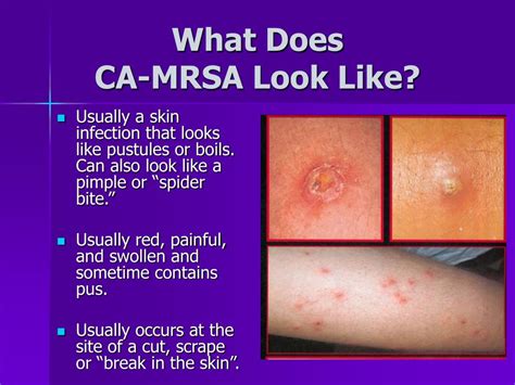 Ppt Working In A Cms Know The Facts About Community Associated Mrsa