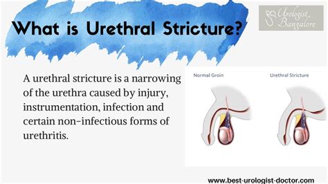 Urethral Stricture Treatment Best Treatment For Urethral Stricture