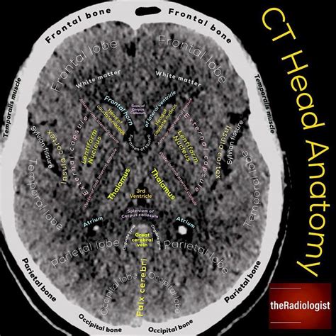 Axial Slice Of A Non Contrast Ct Head At The Level Of The Basal Ganglia The Basal