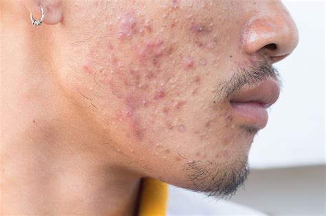 What Is The Best Way To Treat Acne In Men Dr Ben Medical Mens Health Singapore Gp Clinic