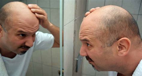 A Look At The Newest Baldness Cures On The Market Florida Independent