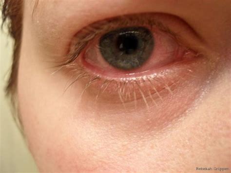 18 Most Common Bloodshot Eyes Causes Healthpulls
