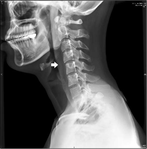 Lateral View Of The Cervical Plain Radiograph Showed A Large Area Of