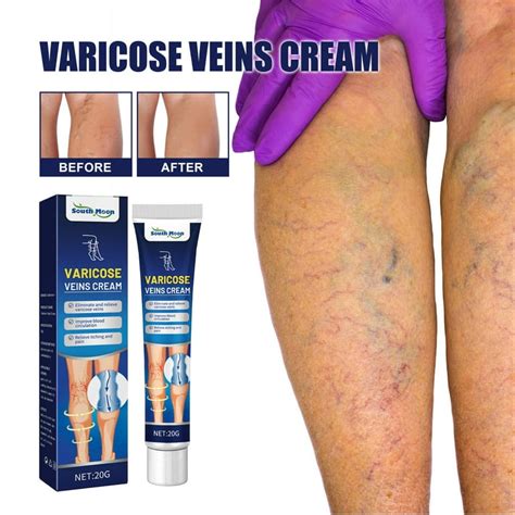 Varicose Vein Makeup For Legs Saubhaya Makeup