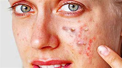 Although it is yet to be ascertained what its causes are, it is suspected that the triggers could be poor grooming habits, stress, a compromised immune system and skin conditions such as dermatitis. Reddit's Top Pops 2018 - Cysts, Blackheads & Pimple ...