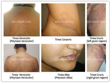 Careful examination of the affected areas will reveal a slight increase in superficial scale. Tinea Corporis: Treatment, Causes, Symptoms, Diagnosis ...