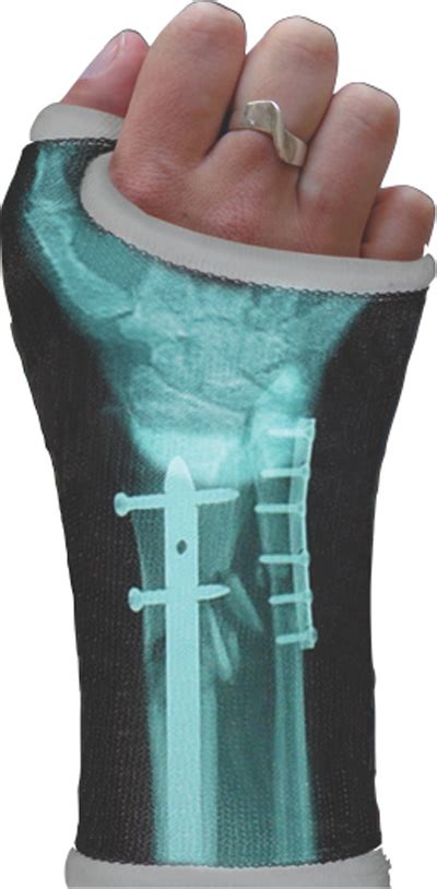 Orthopedic Casts Custom Designed With Your Own X Ray