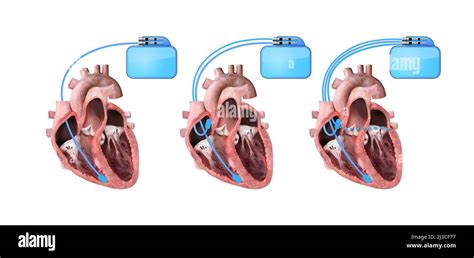 Corazón Y Marcapasos Cardíaco Sobre Fondo Blanco 3d Ilustración
