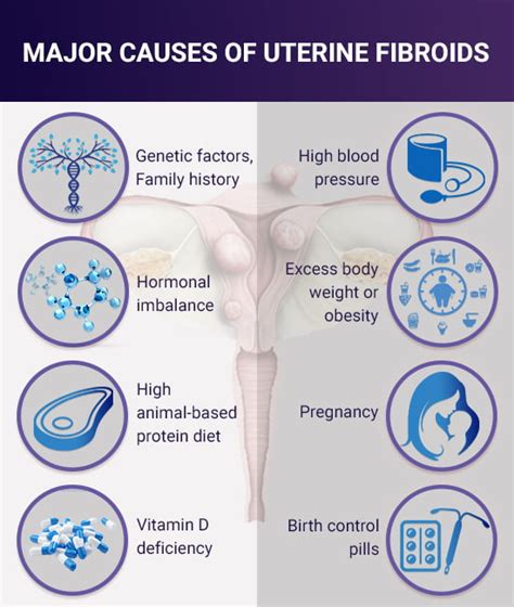 Fibroids Causes Vein Endovascular Medical Care
