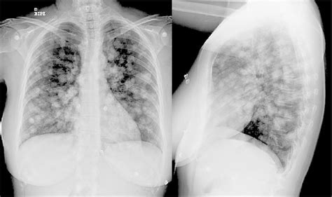 Radiografías Pa Y Lateral Que Muestran La Imagen Típica De Metástasis