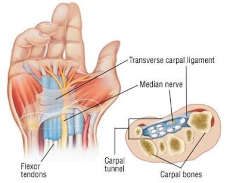 Carpal Tunnel Diagram Ryde Natural Health Clinic