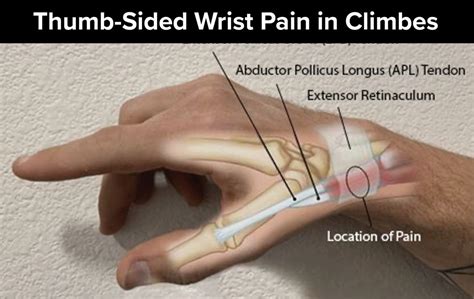 Thumb Sided Wrist Pain In Climbers A Case For De Quervain
