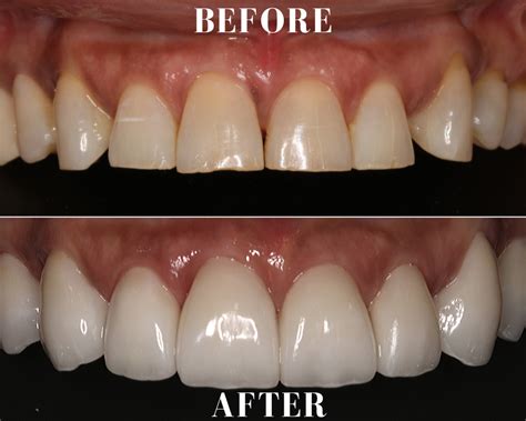 case 12 porcelain veneers upper ocean breeze prosthodontics