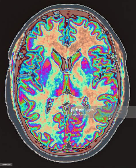 Mri Scan Of Brain High Res Stock Photo Getty Images