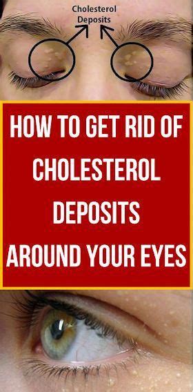 How To Remove The Cholesterol Deposits Around Your Eyes In 2020