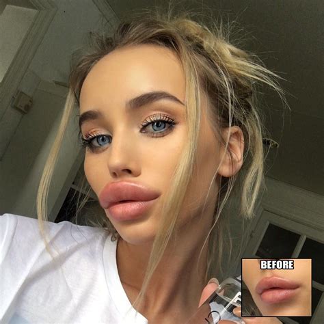 Pin On Lips Fillers