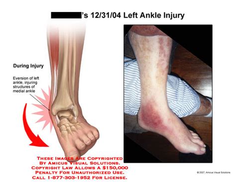 Left Ankle Injury