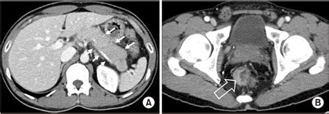 Abdominal Computed Tomography Reveals A Diffuse Edematous Swelling Of