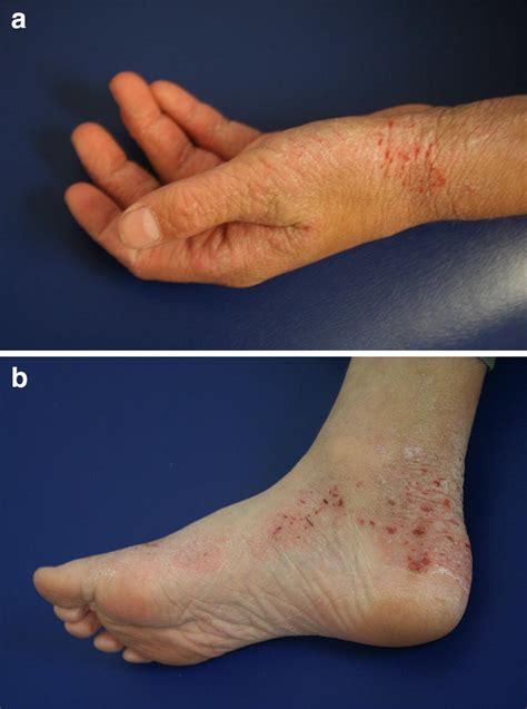 Atopic Dermatitis Springerlink