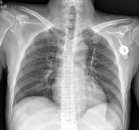 Chest X Ray Showed Inserted Left Subclavian Venous Port And Foreign