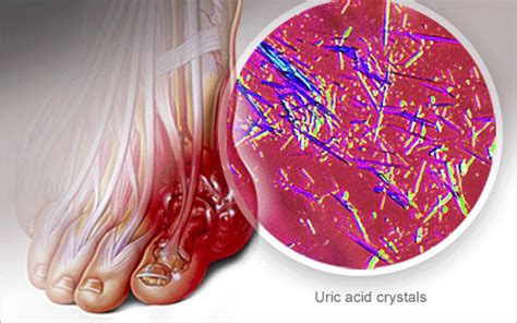 What Is Uric Acid Learn Its Symptoms And Treatment