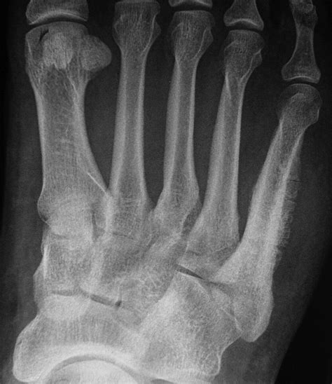 Periosteal Osteosarcoma Of The Fifth Metatarsal A Rare Pedal Tumor The Journal Of Foot And