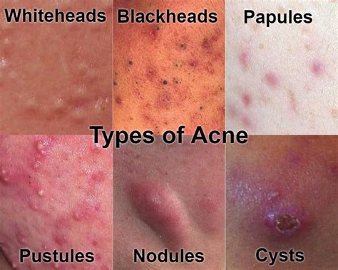 How To Treat Cystic Acne Advice From A Doctors Perspective